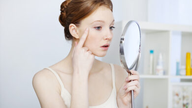 Acne Scars