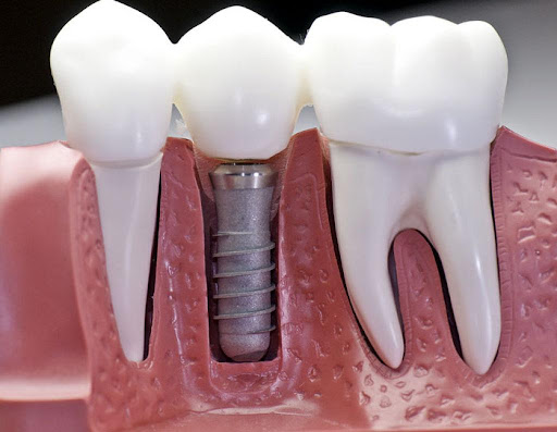 Dental implants are special posts that are implanted into the gums and bone tissue for subsequent installation of crowns on them. Such pins are made of high-strength materials - mainly titanium since it does not enter into chemical interaction with the body and is safe for it. Implants are installed in the place of the missing tooth and are, in fact, an artificial root of the future new tooth.