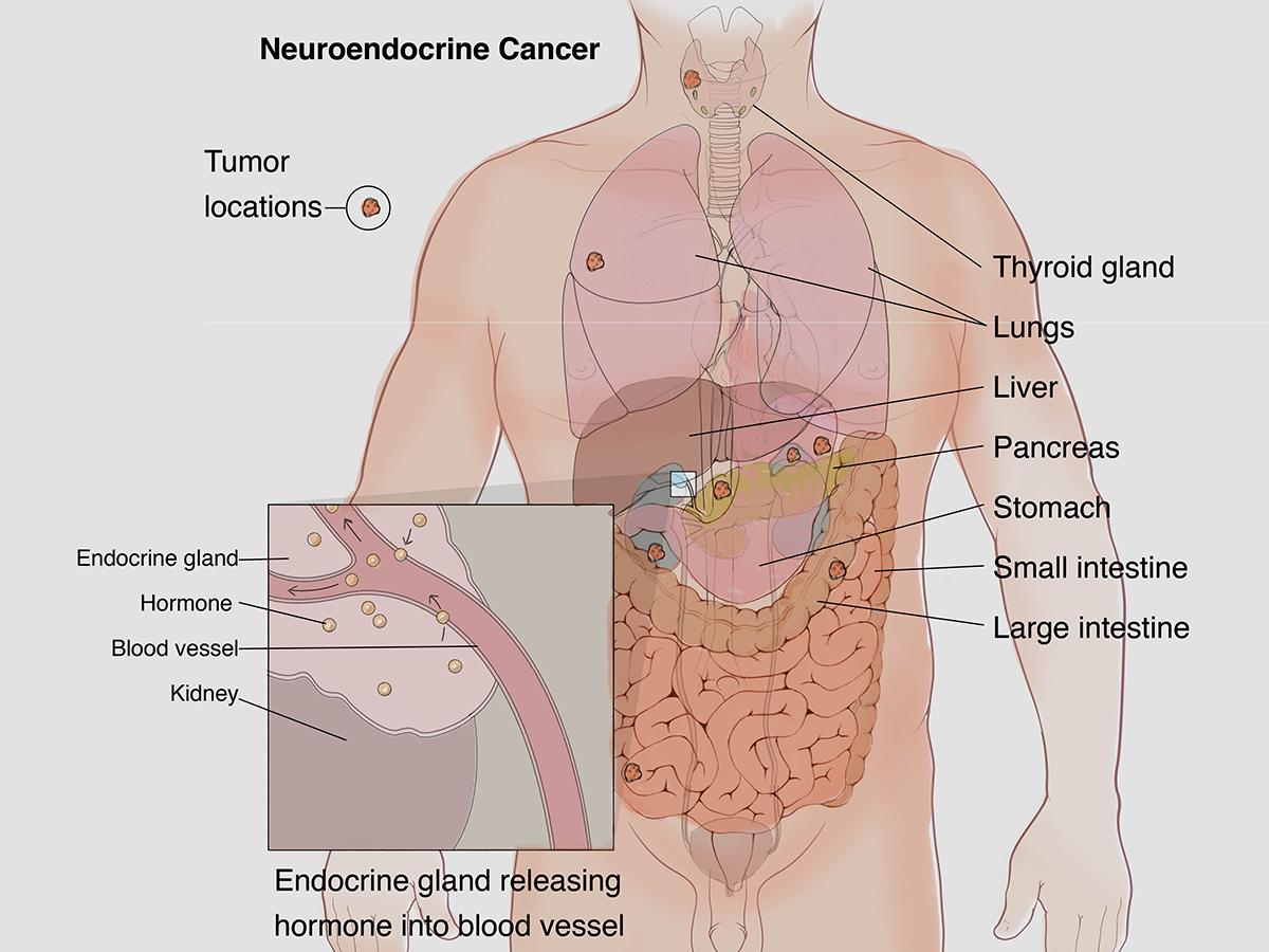 Neuroendocrine Cancer