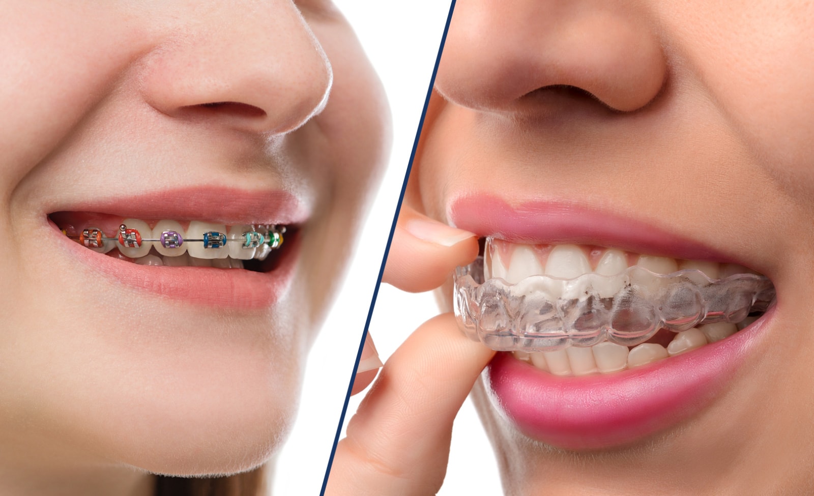 Invisalign vs. Traditional Braces