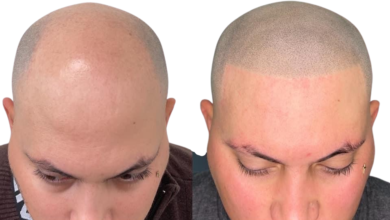 Scalp Micropigmentation