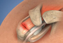 Rotator Cuff Surgery