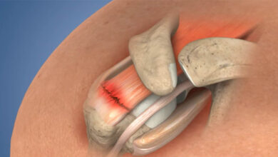Rotator Cuff Surgery