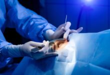 Cataract Surgery