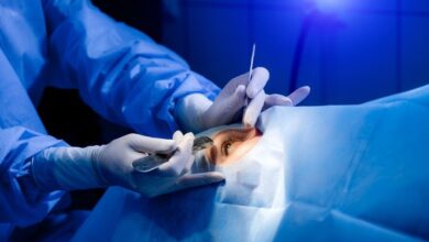 Cataract Surgery