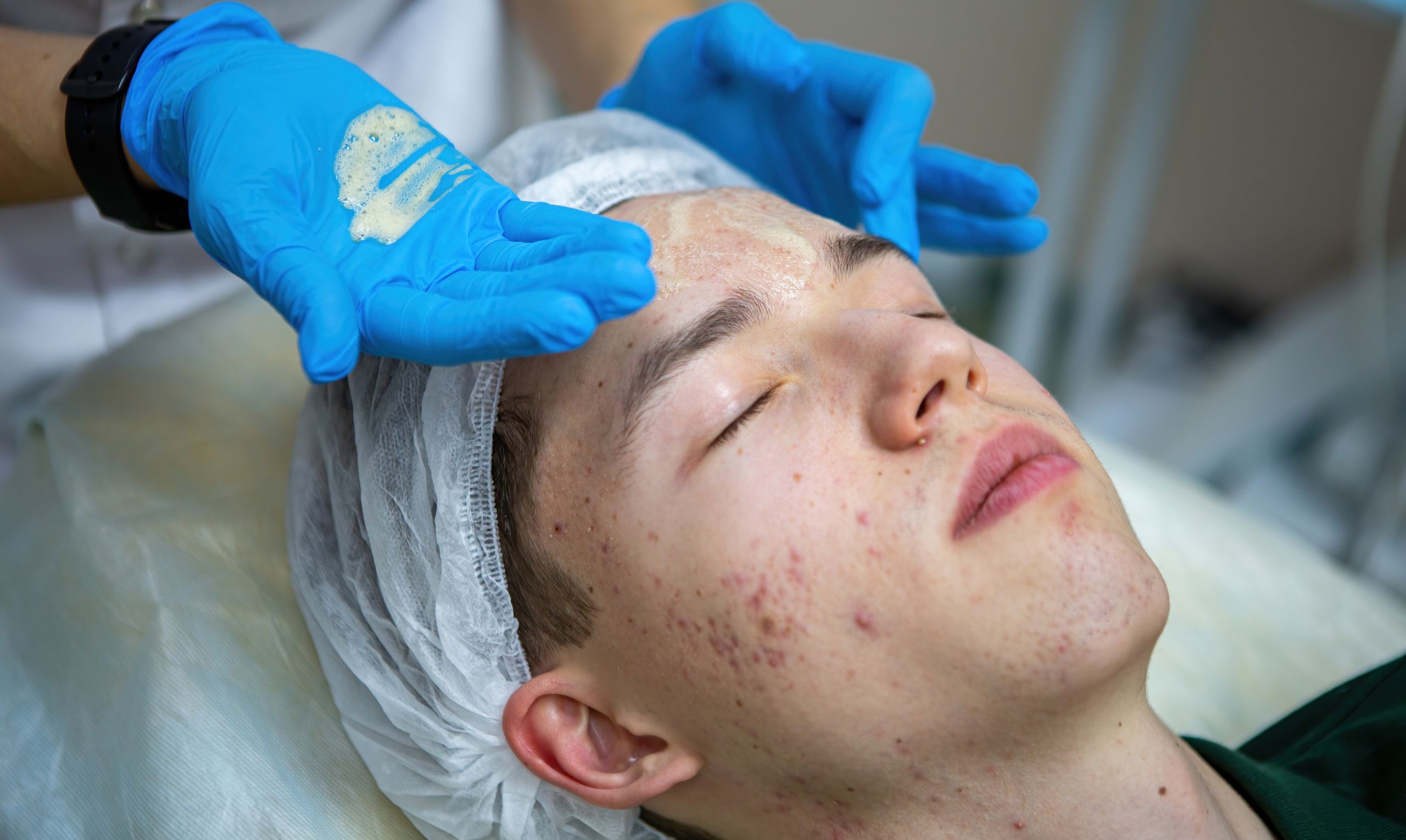 Acne Dermatologist