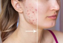 Acne Scar Treatment