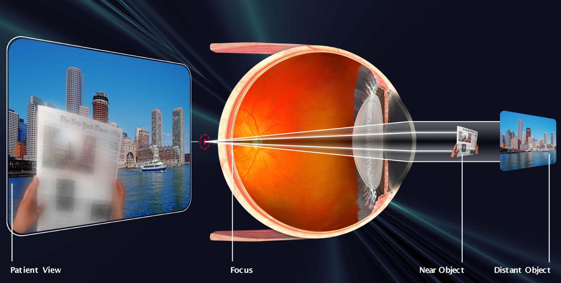 Vision Becomes Presbyopic