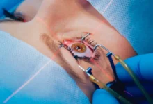 Vision Correction Surgery