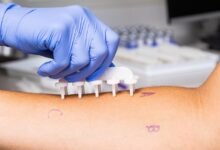 Allergy Test