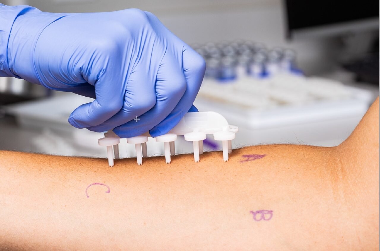 Allergy Test