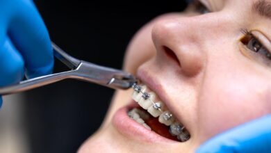 Braces Treatment