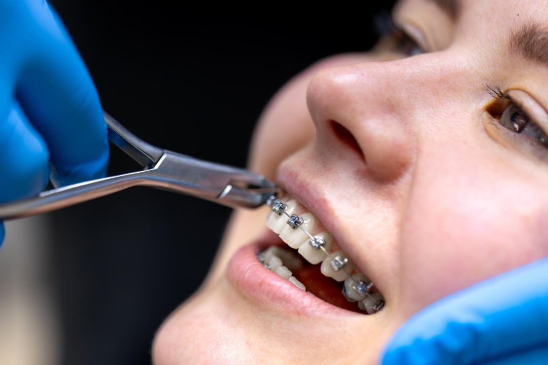 Braces Treatment