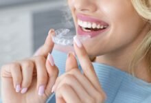 Clear Aligners