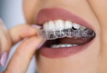 Invisalign